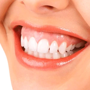 gummy smile lip repositioning dental treatment