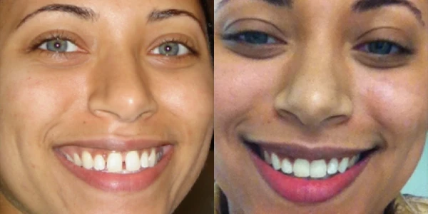 Invisalign-Antes-Depois-Caso-06