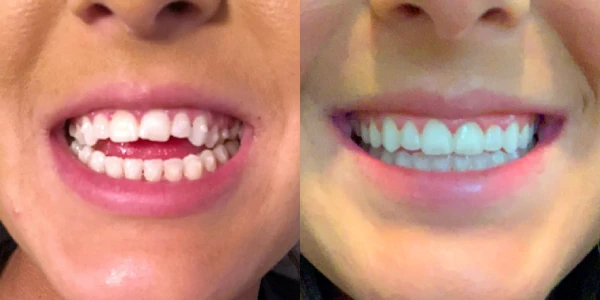 Invisalign-Antes-Depois-Caso-08