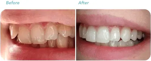 invisalign-antes-depois-dentes-tortos-pra-dentro